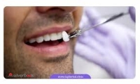 ونیر کامپوزیت دندان اصلاح لبخندهالیوودی،دندانپزشکی